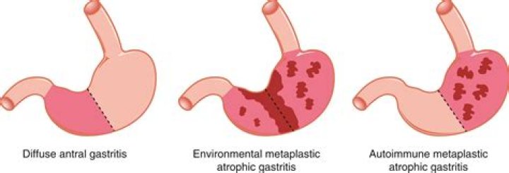 How is metaplastic atrophic gastritis diagnosed?